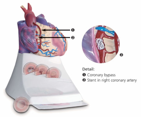 Life Size Diseased Heart Model - Image 2