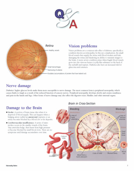 Understanding Diabetes Flip Chart - Image 3