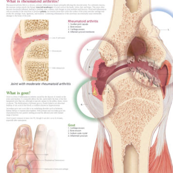 Arthritis