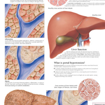 Hepatitis