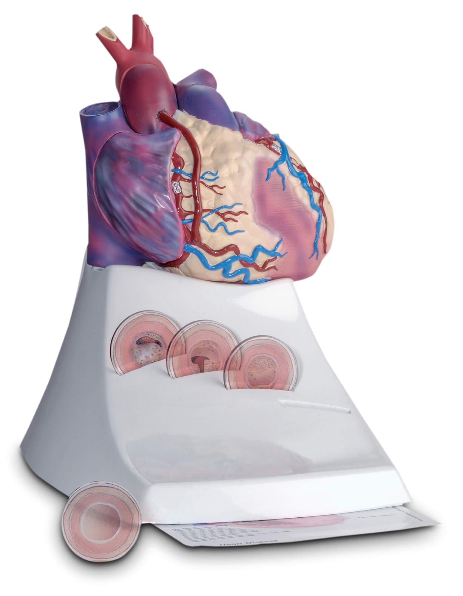 diseased heart model