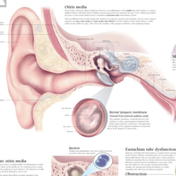 Middle Ear Infection