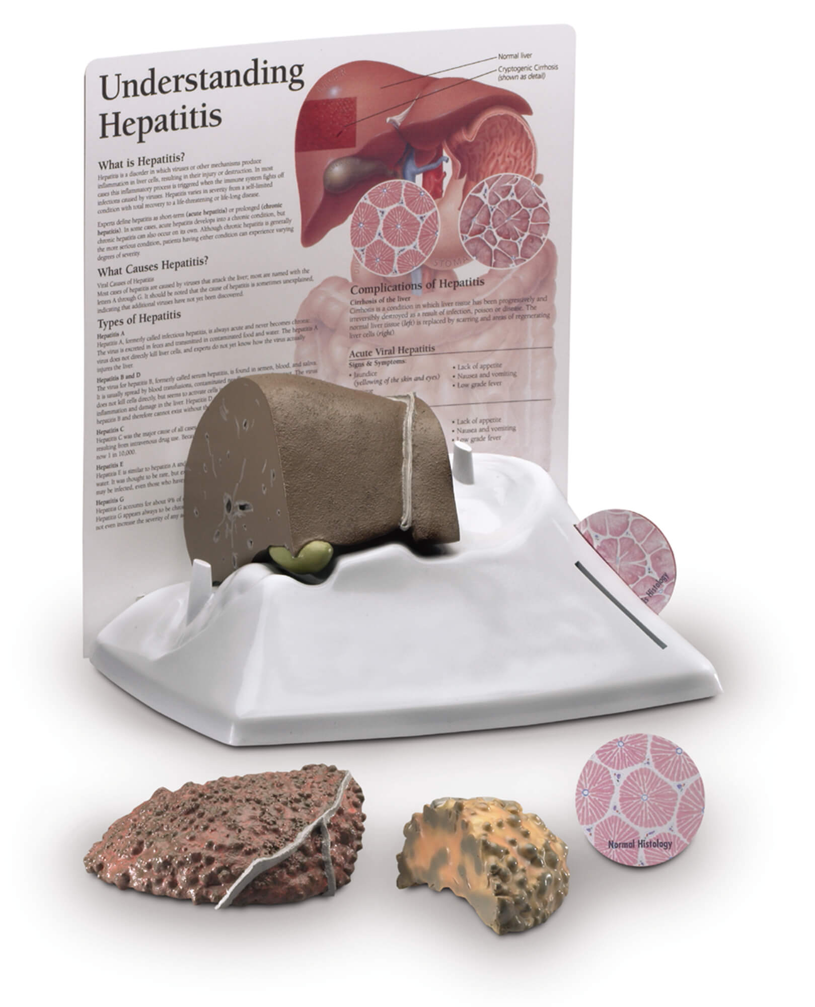 Hepatitis model