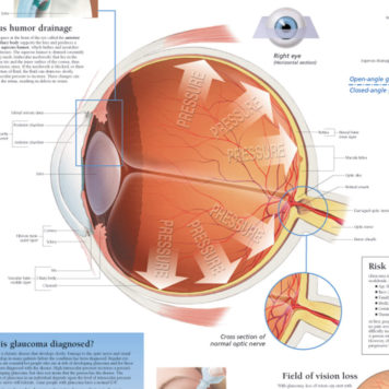 Glaucoma