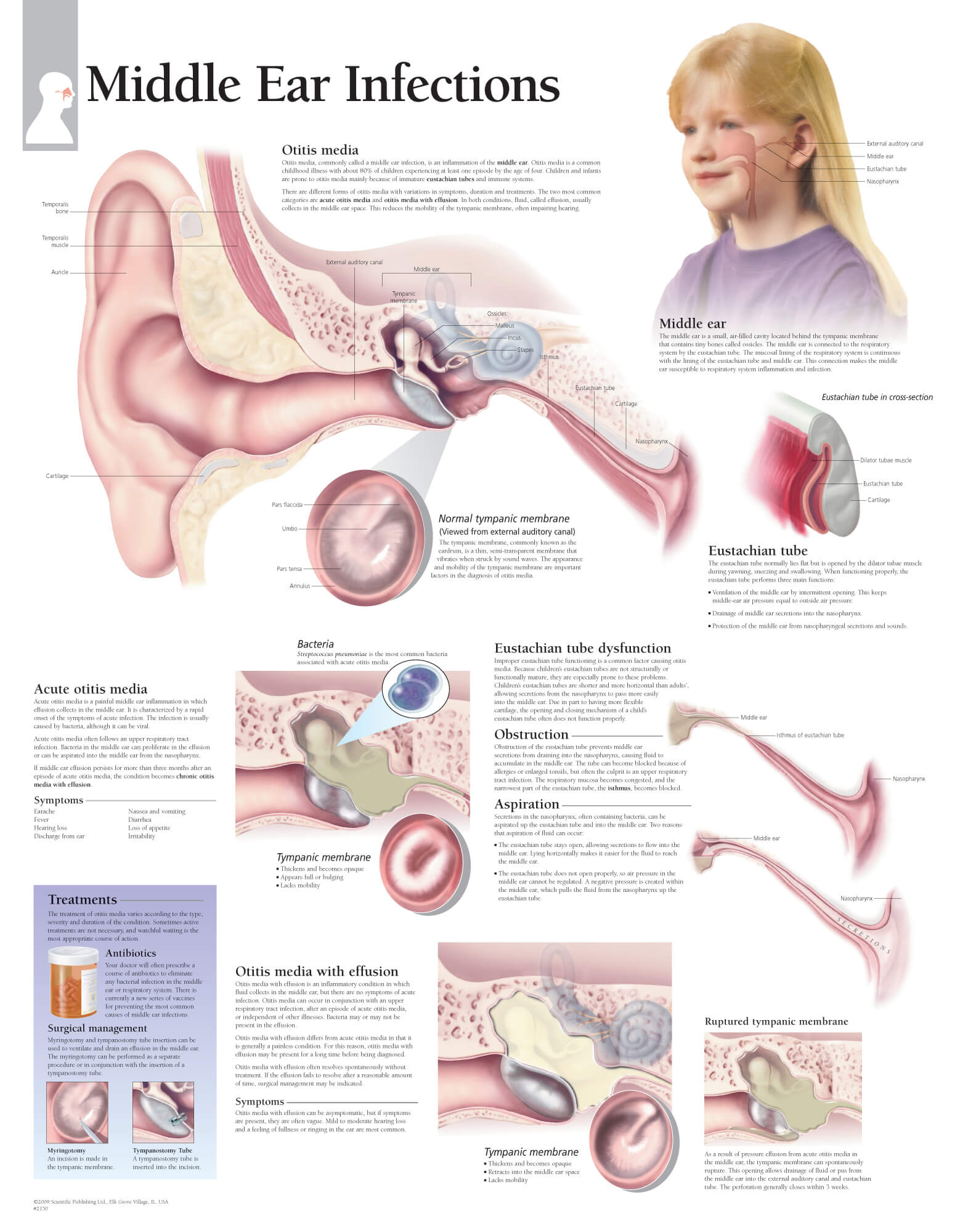 Middle Ear Infection Chart