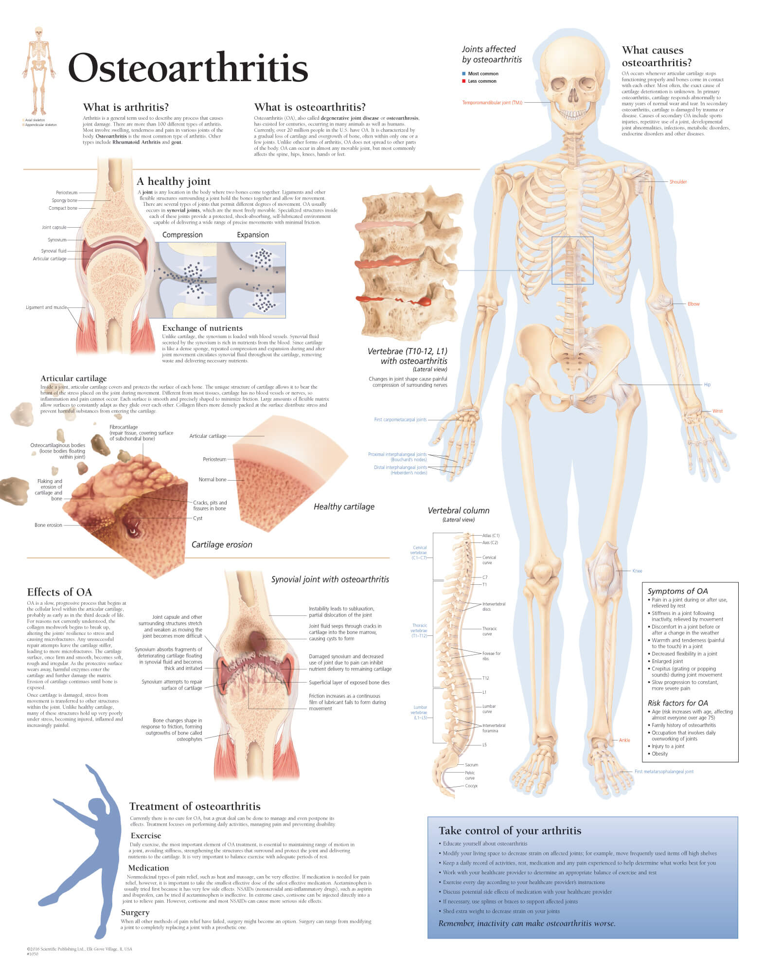 osteoarthritis