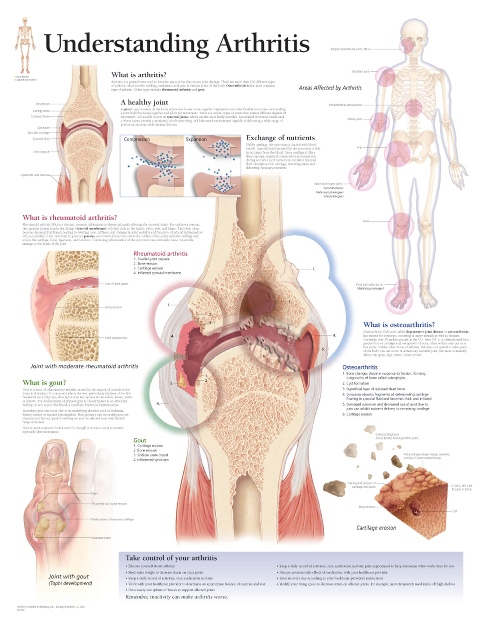 arthritis