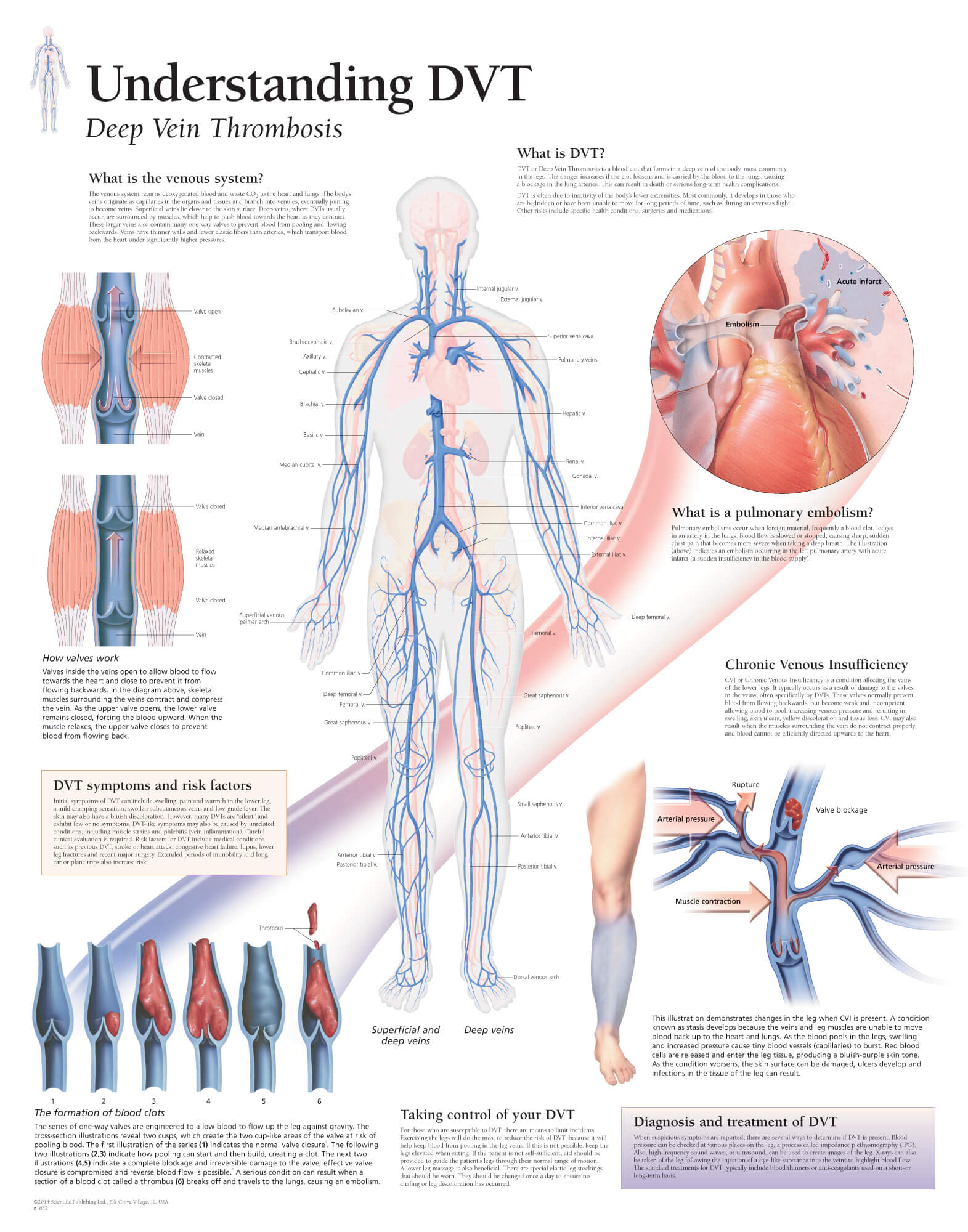 Understanding DVT | Scientific Publishing