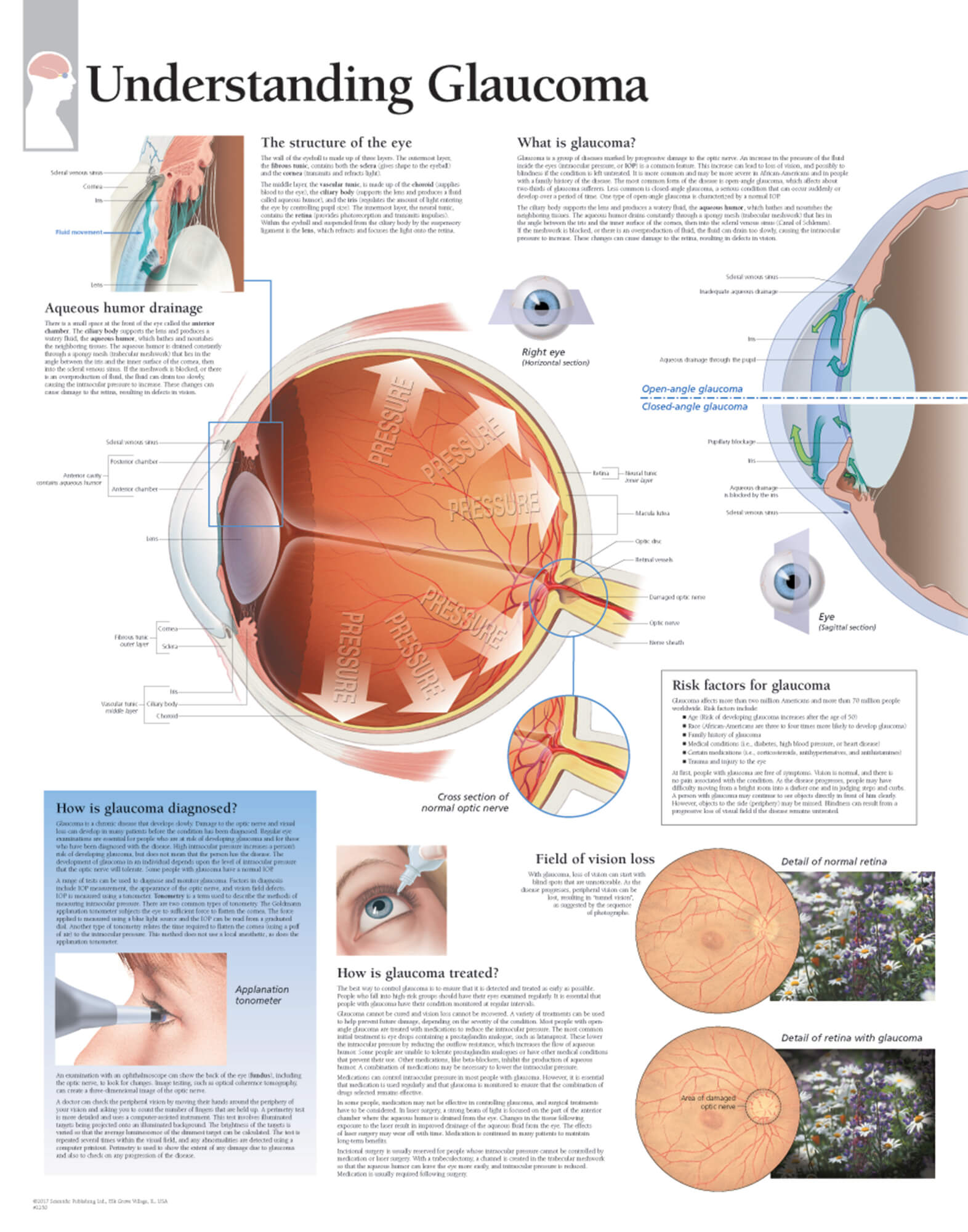 glaucoma