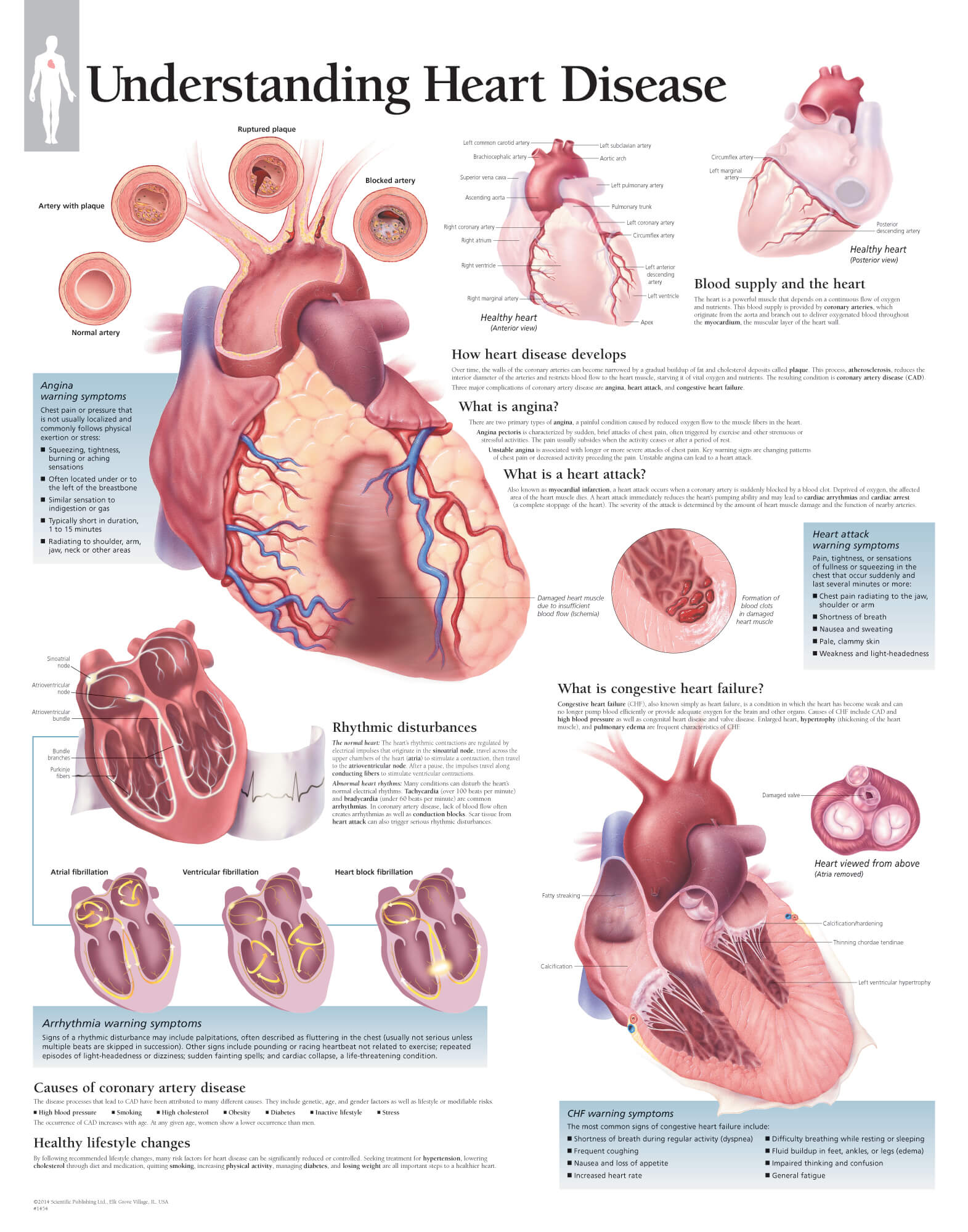 heart disease