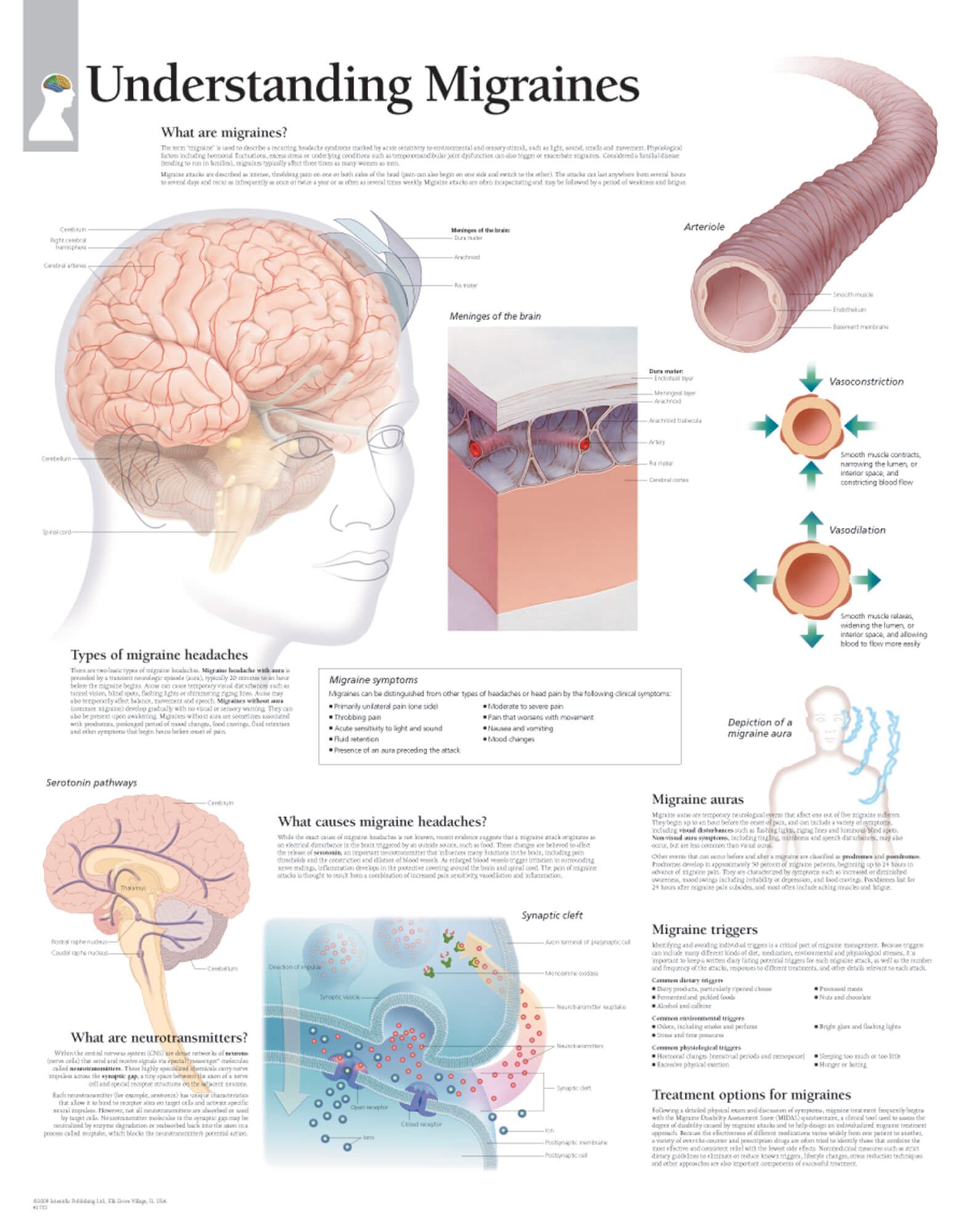 migraines