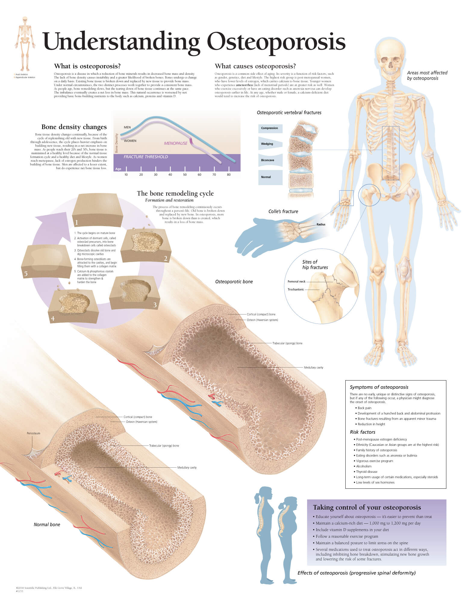 osteoporosis