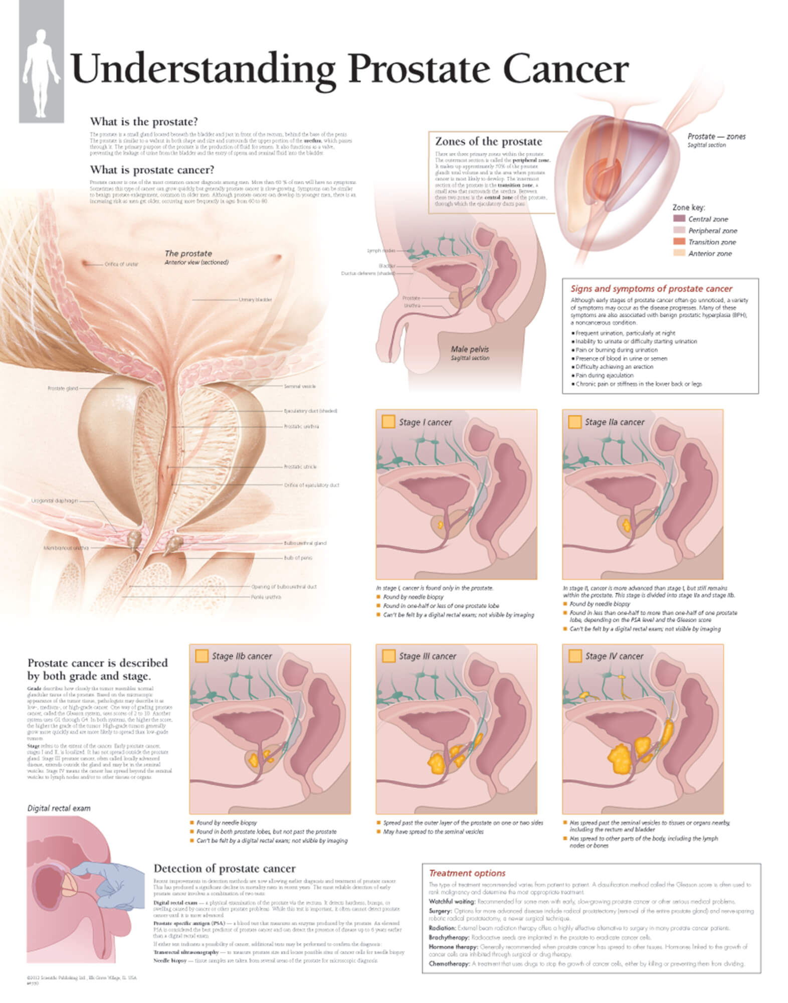 prostate cancer