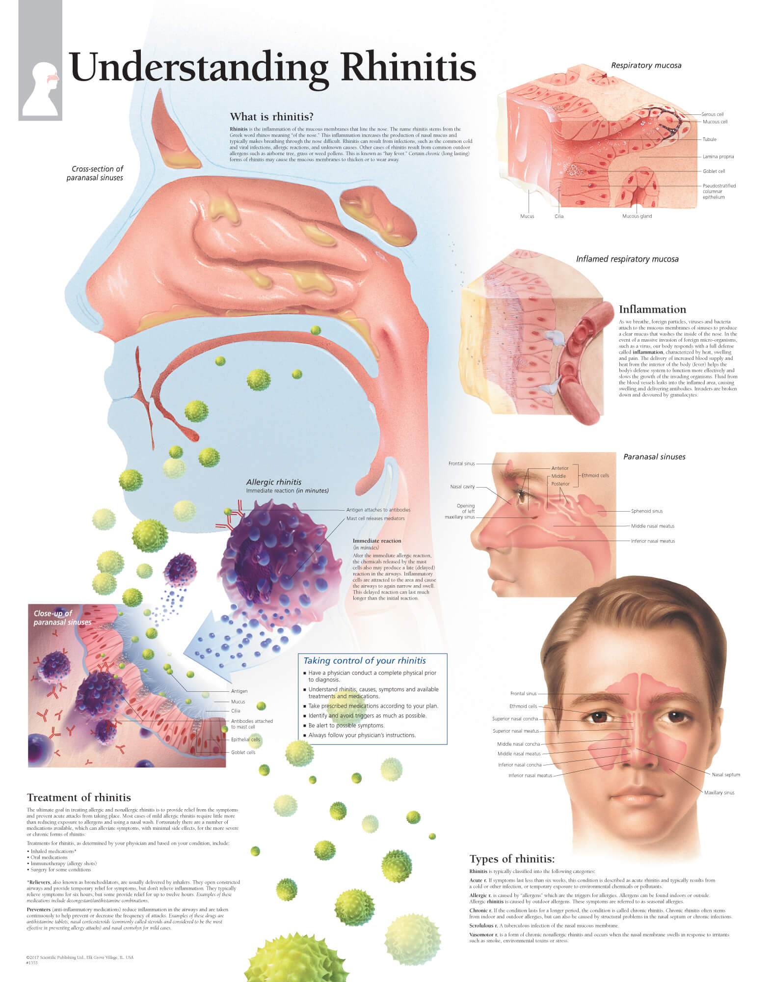 rhinitis