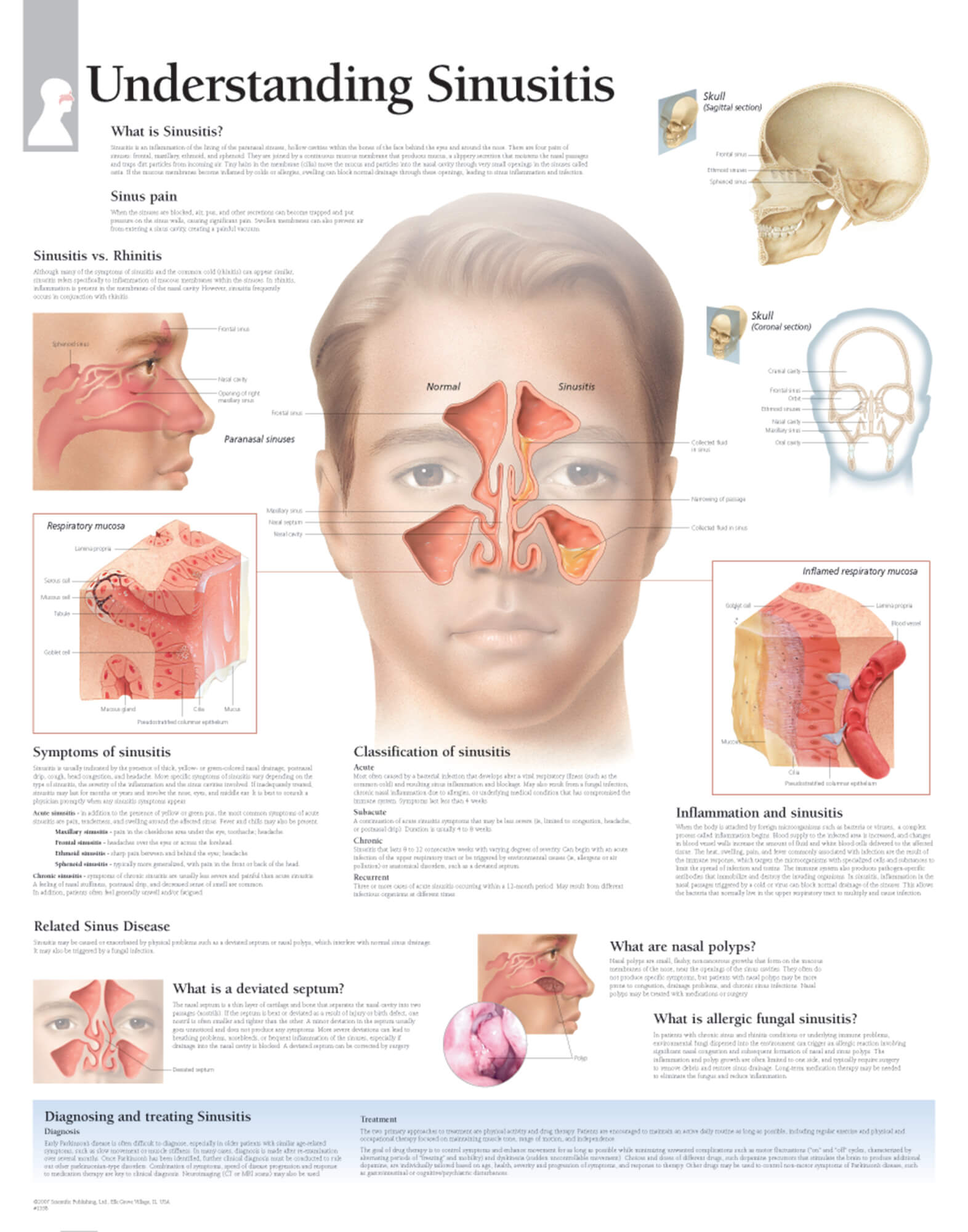 sinusitis